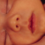 Mioclonusul neonatal benign
