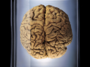 Tomografia cerebrală Tomografia cerebrală