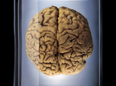 Tomografia cerebrală Tomografia cerebrală