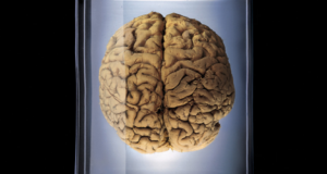 Tomografia cerebrală Tomografia cerebrală