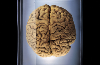 Tomografia cerebrală Tomografia cerebrală