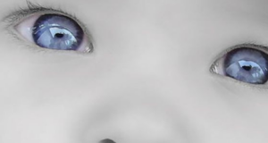 Hidrocefalia fetală Hidrocefalia fetală