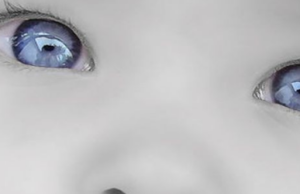 Hidrocefalia fetală Hidrocefalia fetală