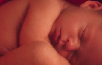 Hidrocefalia sugarului Hidrocefalia sugarului