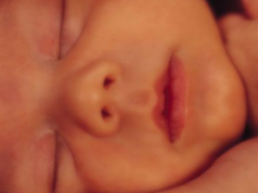 Mioclonusul neonatal benign Mioclonusul neonatal benign