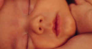 Mioclonusul neonatal benign Mioclonusul neonatal benign