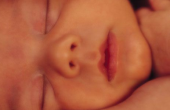 Mioclonusul neonatal benign Mioclonusul neonatal benign