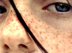 Sindromul X fragil Sindromul X fragil