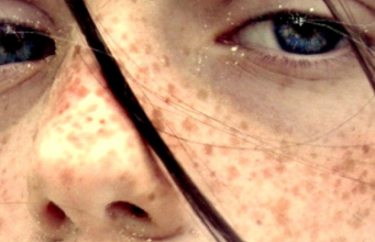 Sindromul X fragil Sindromul X fragil