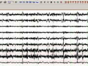 Electromiografia (EMG) Electromiografia EMG