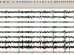 Electromiografia (EMG) Electromiografia EMG