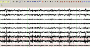 Electromiografia (EMG) Electromiografia EMG