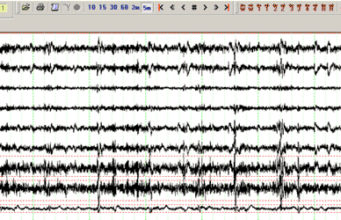 Electromiografia (EMG) Electromiografia EMG