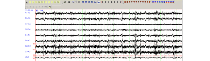 Electromiografia (EMG) Electromiografia EMG