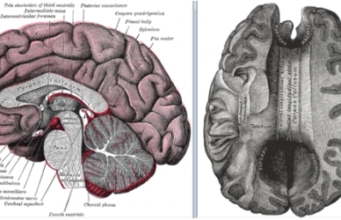 Agenezia de corp calos Corp Calos - sectiune