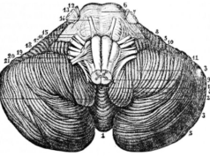 Sindrom Dandy – Walker sindrom Dandy - Walker