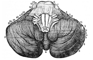 Sindrom Dandy – Walker sindrom Dandy - Walker
