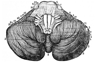Sindrom Dandy – Walker sindrom Dandy - Walker