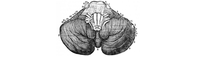 Sindrom Dandy – Walker sindrom Dandy - Walker