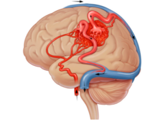 Malformația venei Galen Malformația venei Galen