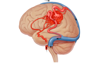 Malformația venei Galen Malformația venei Galen