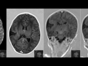 Schizencefalia Schizencefalia