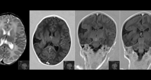 Schizencefalia Schizencefalia