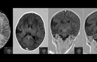 Schizencefalia Schizencefalia