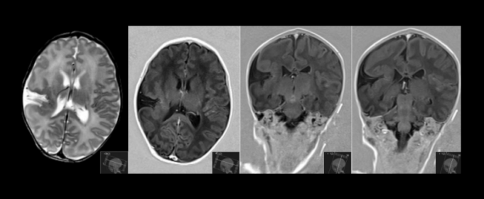 Schizencefalia Schizencefalia
