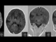 Schizencefalia Schizencefalia