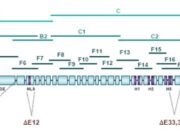 Sindromul Cornelia de Lange Sindrom-Cornelia-de-Lange