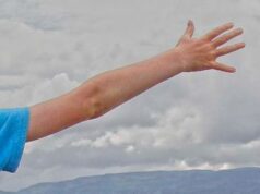 Diskinezia paroxistică kinezigenică Diskinezia paroxistica kinezigenica