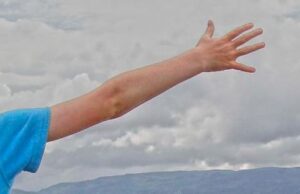 Diskinezia paroxistica kinezigenica Diskinezia paroxistica kinezigenica