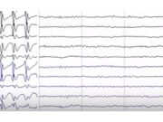 Epilepsia cu absențe mioclonice Epilepsia cu absente mioclonice