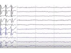 Epilepsia cu absențe mioclonice Epilepsia cu absente mioclonice