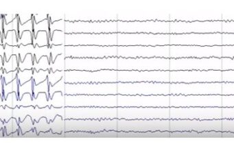 Epilepsia cu absențe mioclonice Epilepsia cu absente mioclonice