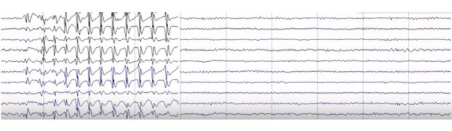 Epilepsia cu absente mioclonice
