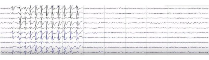 Epilepsia cu absențe mioclonice Epilepsia cu absente mioclonice