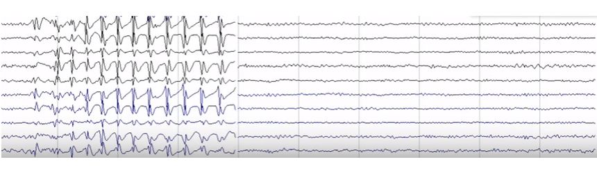 Epilepsia cu absențe mioclonice Epilepsia cu absente mioclonice