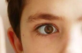 Sindromul opsoclonus-mioclonus Sindromul-opsoclonus-mioclonus