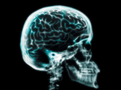 Radiografia craniană Radiografia craniana