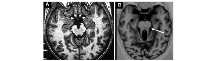Sindrom Joubert Sindrom Joubert