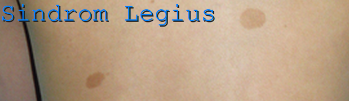 Sindromul Legius și asemănarea cu Neurofibromatoza tip 1 Sindromul Legius