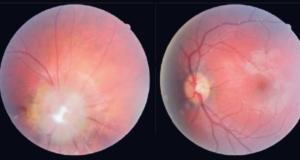 Sindrom Morning Glory Sindrom Morning Glory - oftalmologic