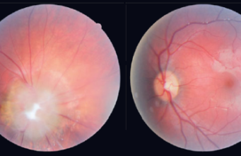 Sindrom Morning Glory Sindrom Morning Glory - oftalmologic