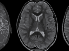 SINDROMUL MOYAMOYA și SINDROMUL DOWN sindrom Moyamoya