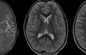 SINDROMUL MOYAMOYA și SINDROMUL DOWN sindrom Moyamoya
