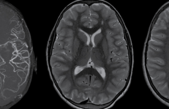 SINDROMUL MOYAMOYA și SINDROMUL DOWN sindrom Moyamoya
