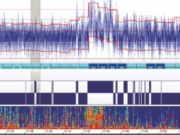 EEG de amplitudine integrată, aEEG aEEG