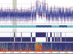 EEG de amplitudine integrată, aEEG aEEG